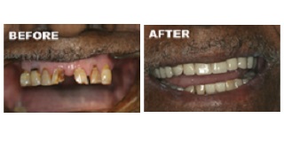 Before and after with dentures