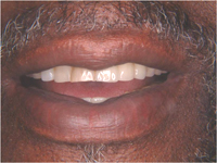 Patient with partial dentures
